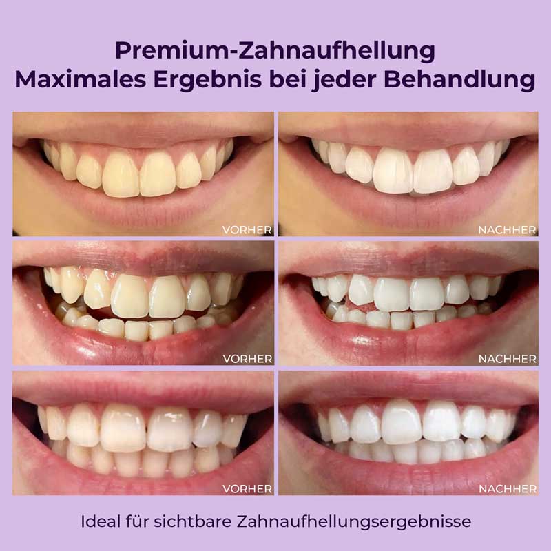 onlysmile Zahnaufhellungsgel 3 x 40 ml 3X40 ml Zahngel