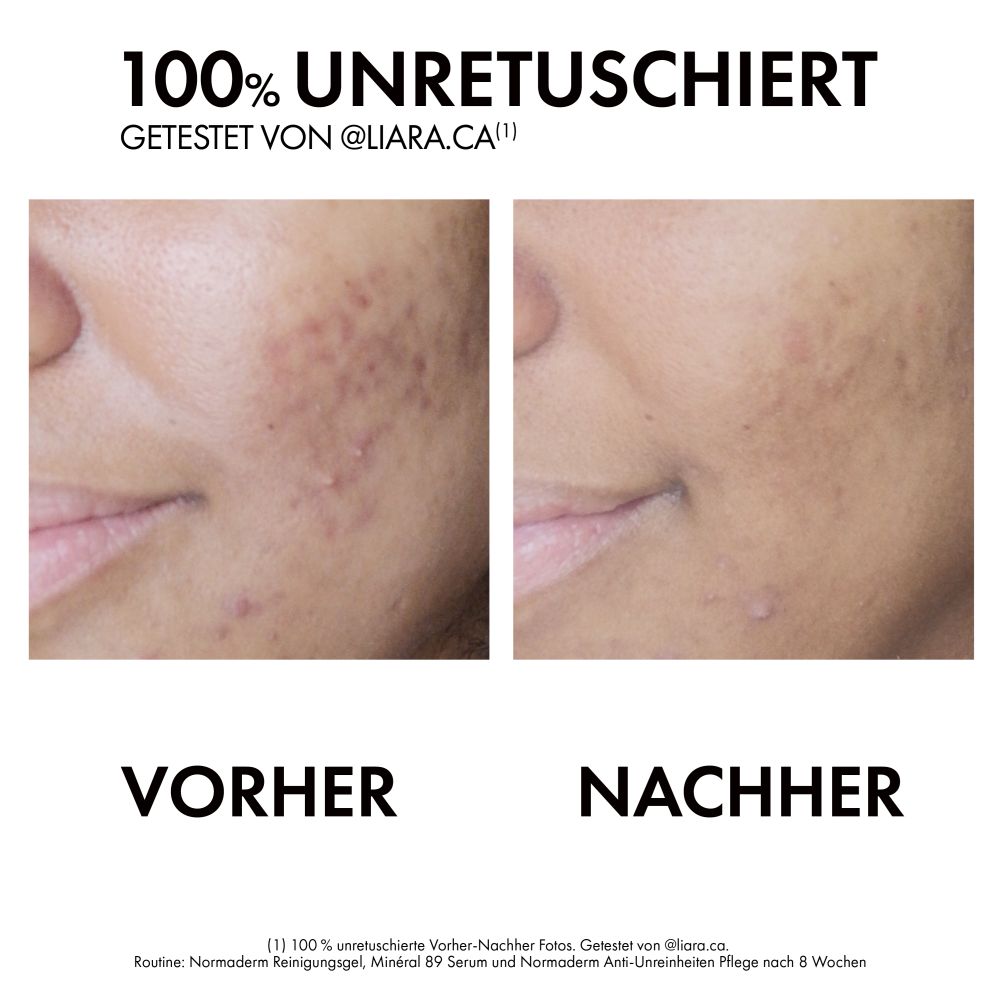 VICHY NORMADERM Anti-Unreinheiten-Pflege  50 ml
