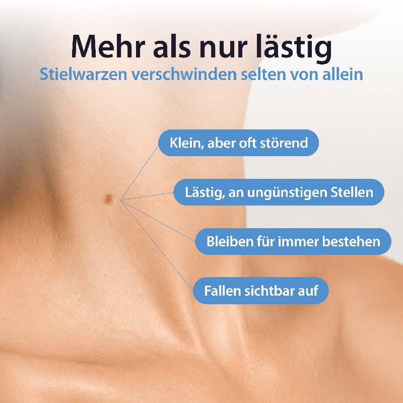 Acetocaustin Stielwarzen Entferner 50 ml Stifte