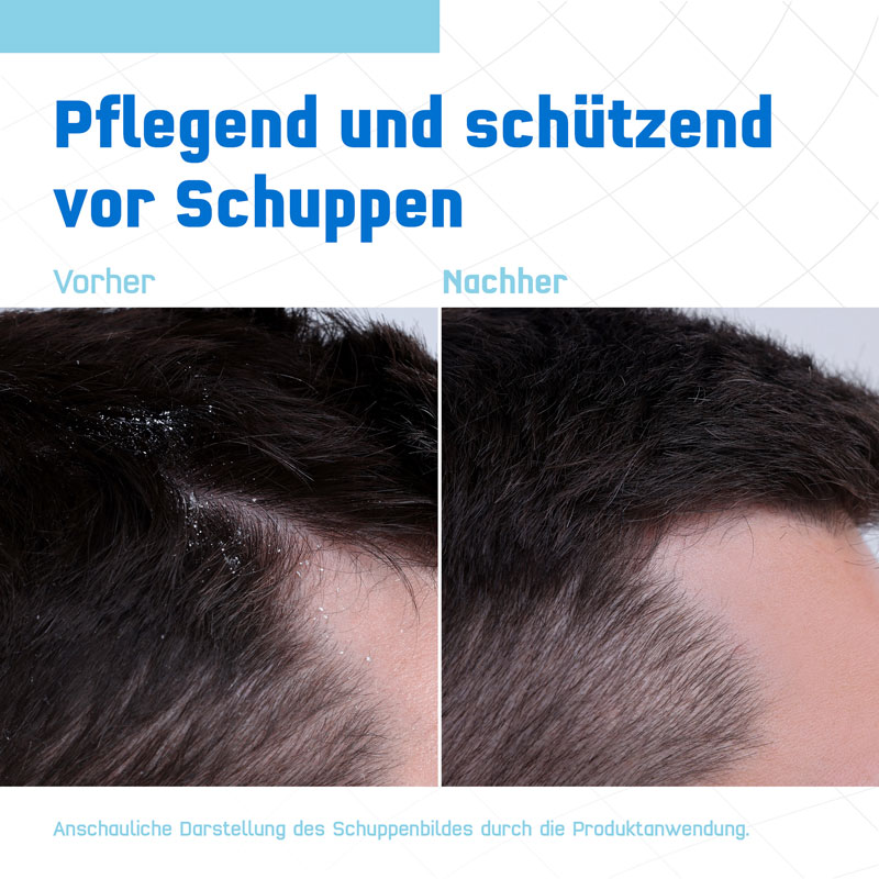 Terzolin Expert Schuppen-Shampoo bei trockener Kopfhaut 200 ml Shampoo