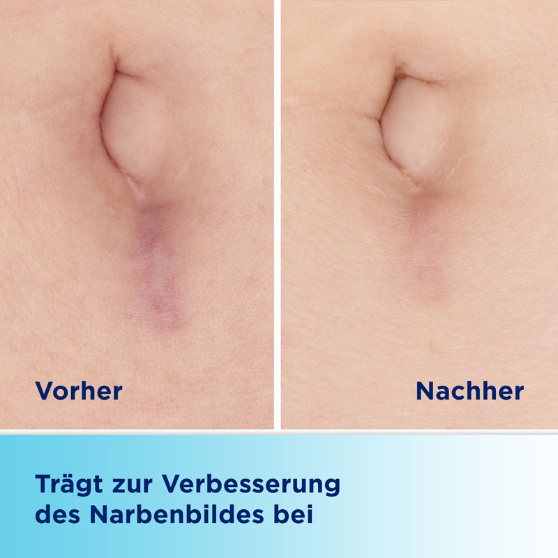 BepanCare Narben-Gel 20 ml Gel