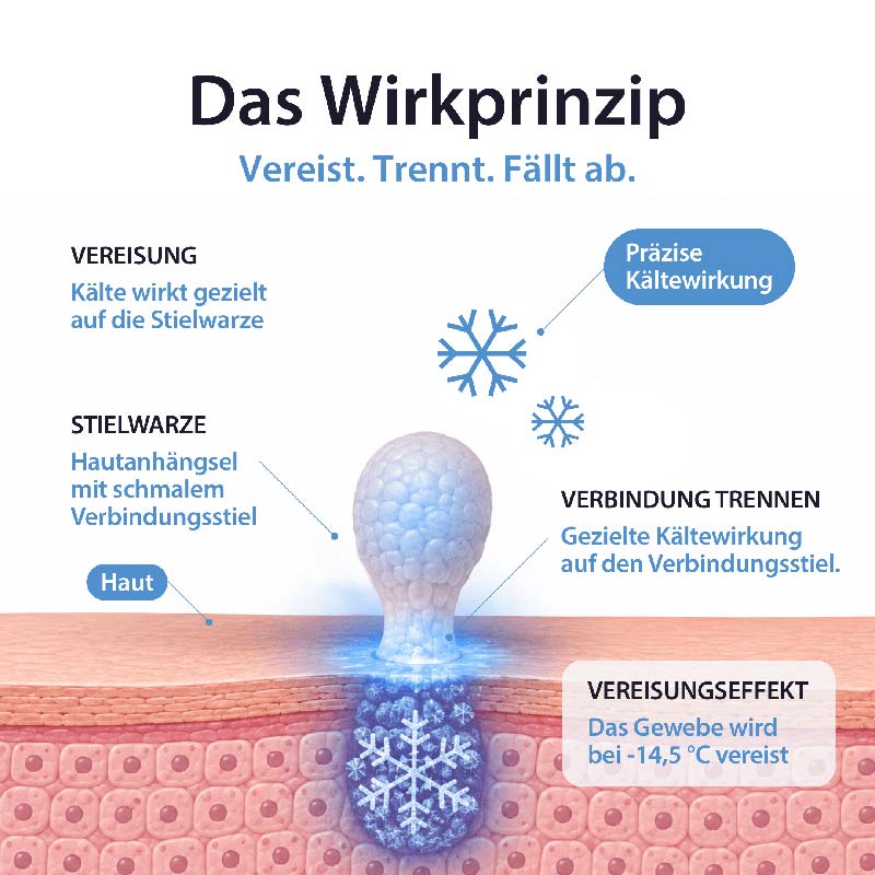 Acetocaustin Stielwarzen Entferner 50 ml Stifte