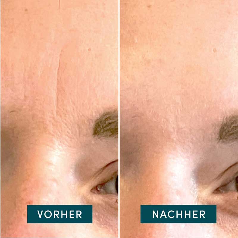 APRICOT Gesicht Patches Hyaluron Mini 24 St Pflaster