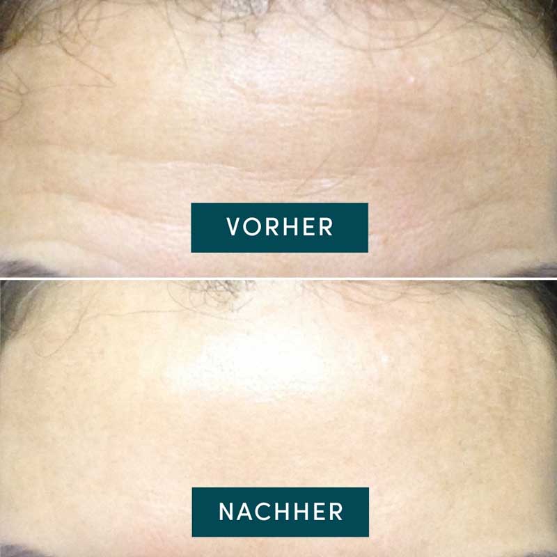 APRICOT Stirn Pad mit Hyaluron, wiederverwendbar 1 St