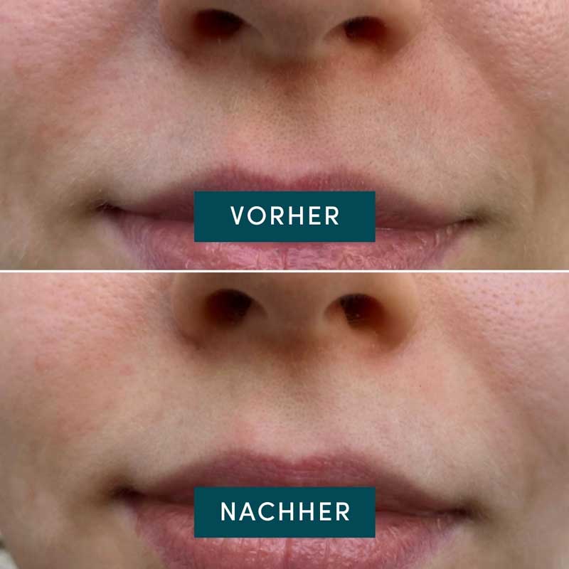 APRICOT Mund Patches Hyaluron Mini 24 St Pflaster
