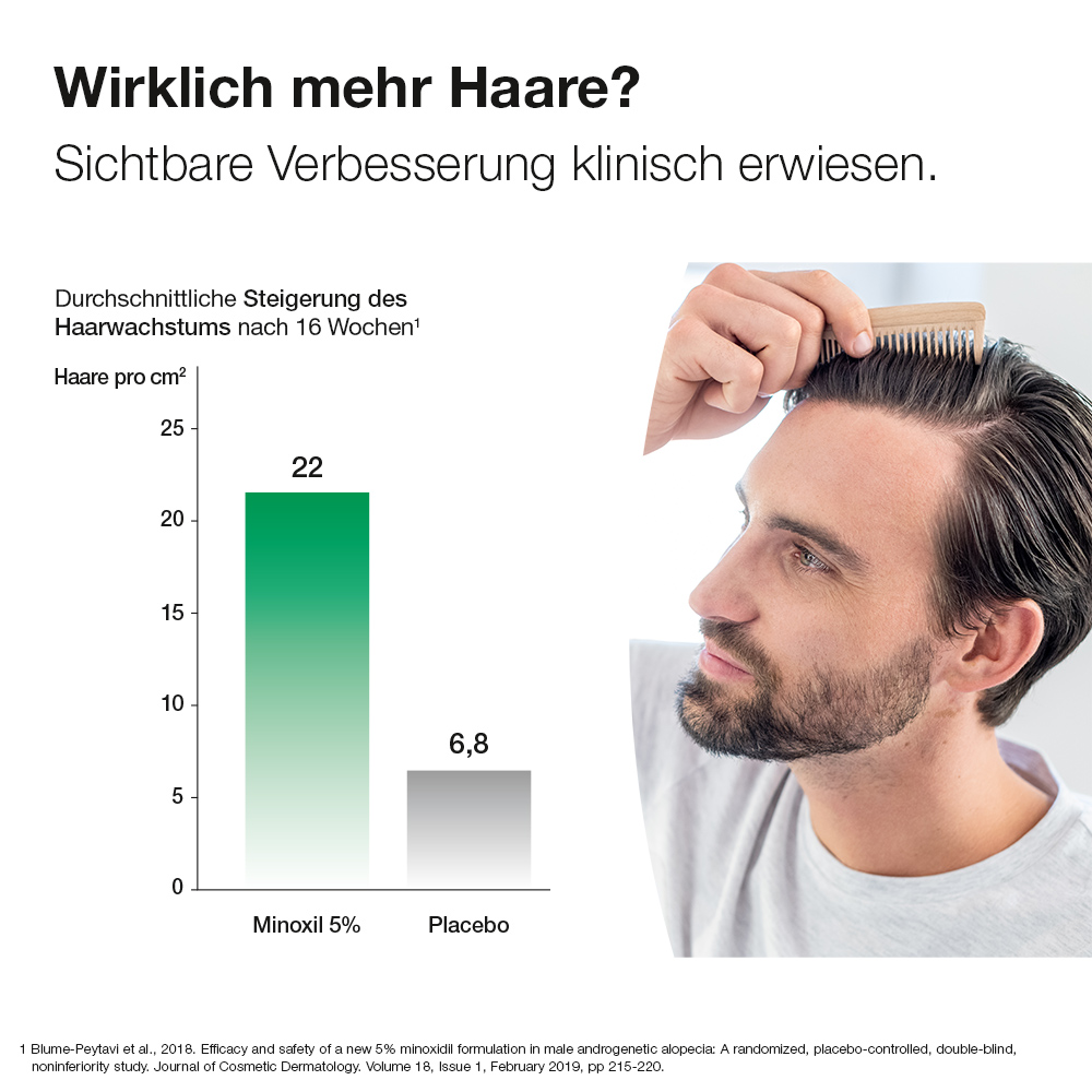 ALOPEXY 5% Lösung zur Anwendung auf der Haut 3X60 ml Lösung