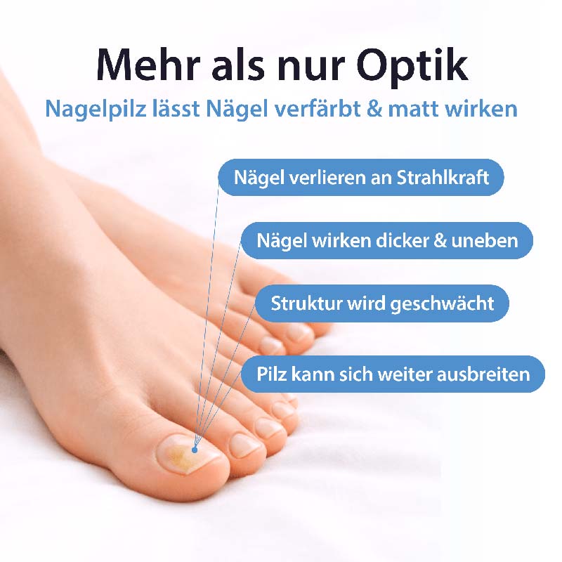 Acetocaustin Nagelpilz Lösung mit Aufhellung 9 ml Lösung